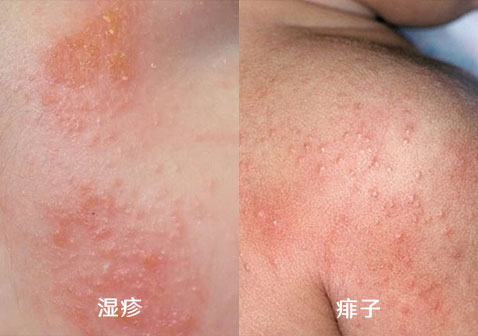 湿疹和热疹的这些区别，你知道吗？